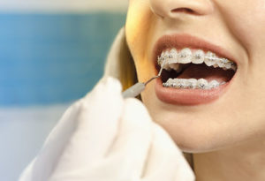 mouth being looked at by orthodontist, dental braces tx