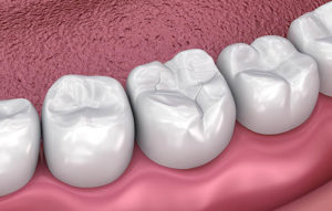 image of dental fillings and sealants pasadena tx