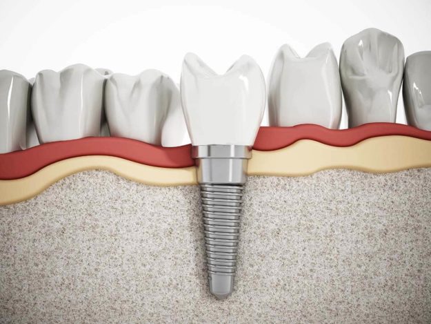 dental implants (1) diagram of dental implants