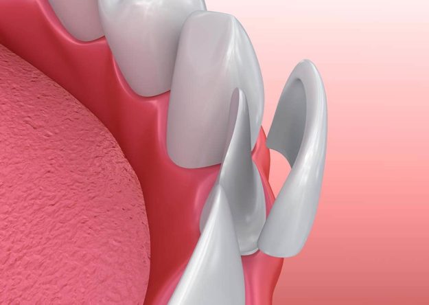 dental veneers example of dental veneers being placed