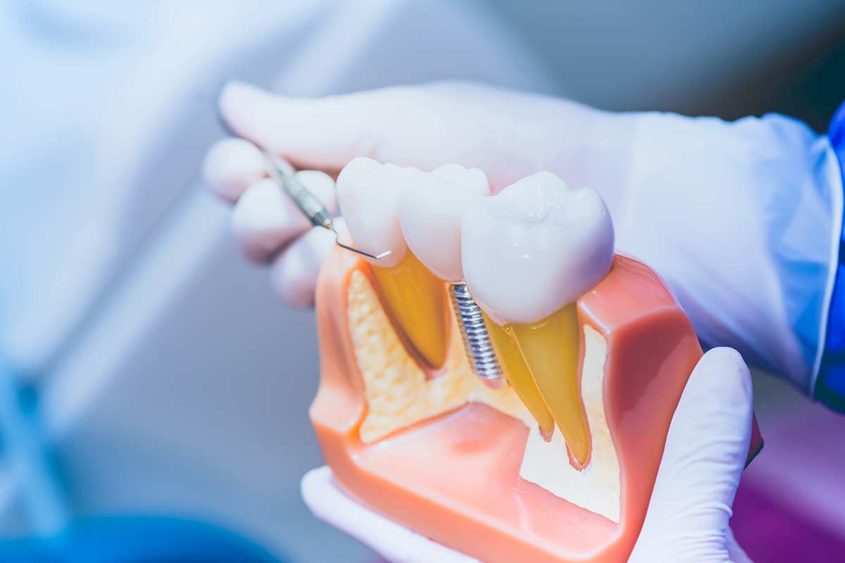 dental implants a doctor demonstrates procedures for dental implants