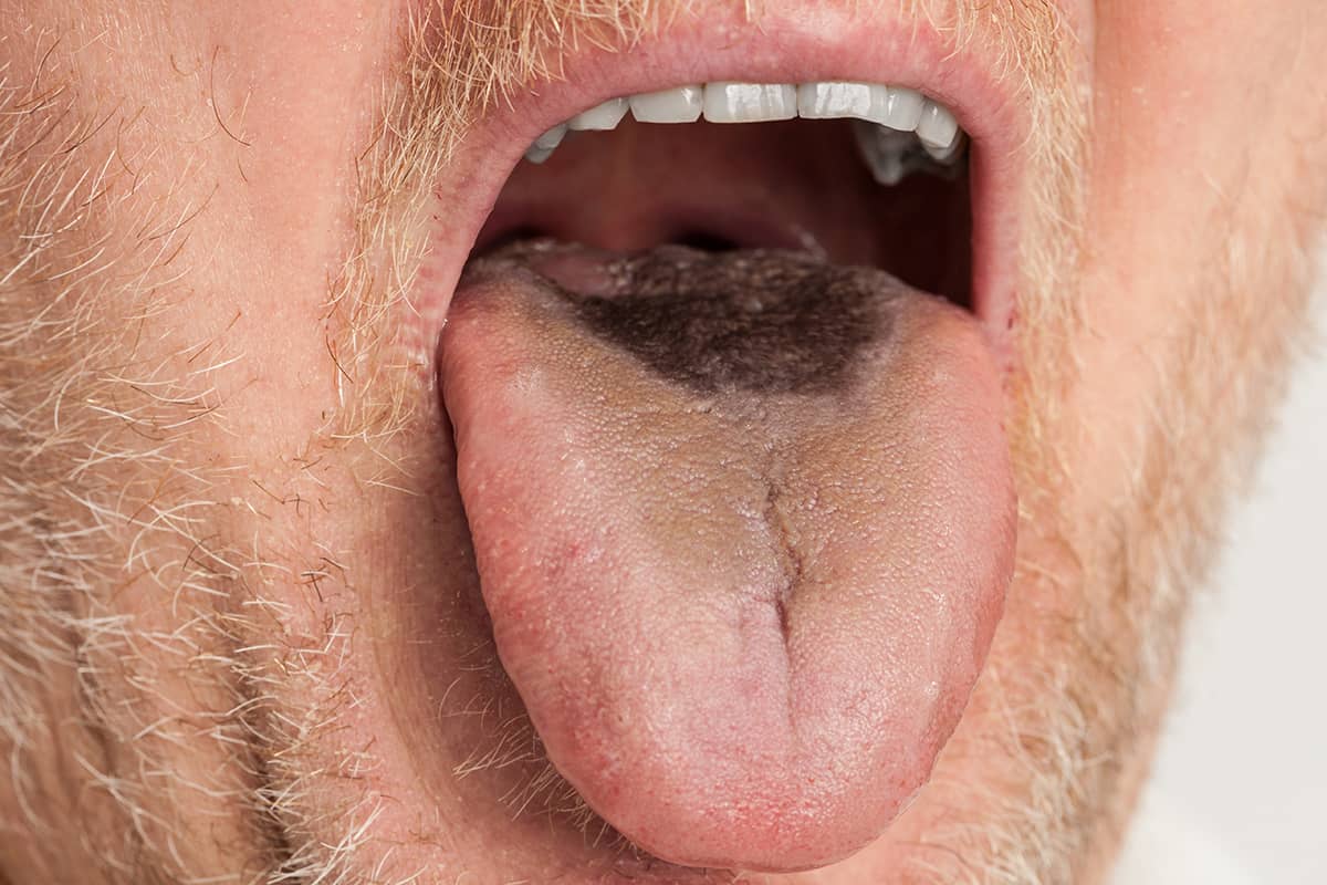 Why A Mans Tongue Turned Black And Hairy Following A Stroke