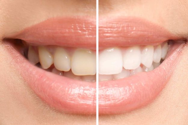 dental stains a woman gets rid of dental stains with teeth whitening