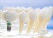 model of a single tooth implant