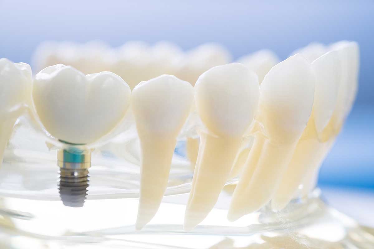 model of a single tooth implant