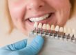 benefits of dental veneers pasadena texas