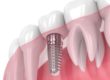 how do dental implants work pasadena texas