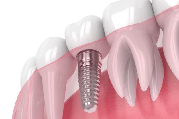 How Do Dental Implants Work how do dental implants work pasadena texas